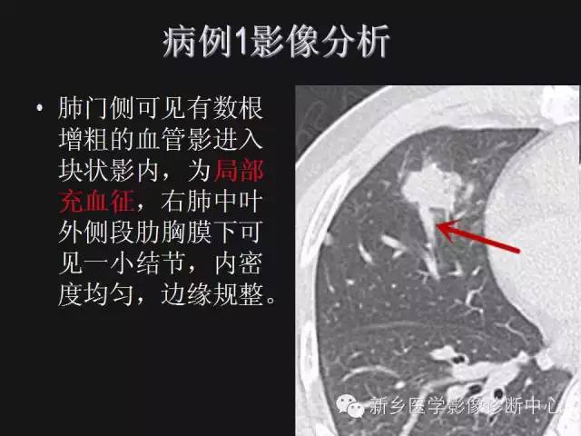 【病例】肺炎性假瘤2例影像表现与鉴别