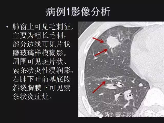 【病例】肺炎性假瘤2例影像表现与鉴别