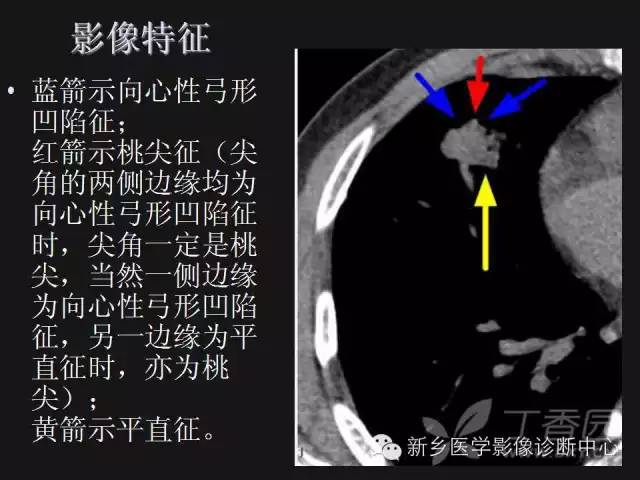 【病例】肺炎性假瘤2例影像表现与鉴别