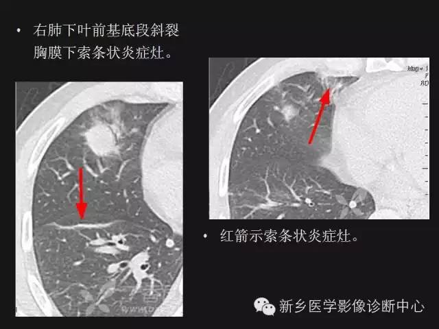 【病例】肺炎性假瘤2例影像表现与鉴别