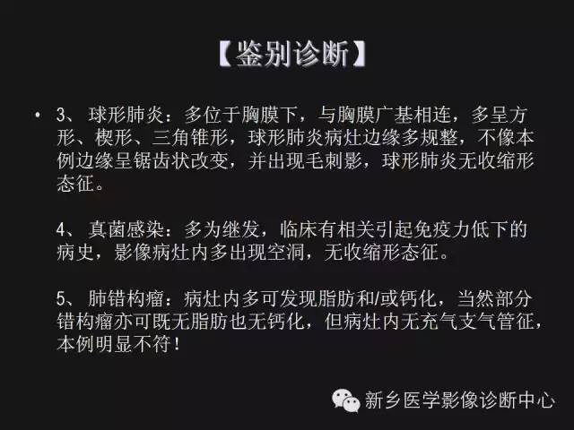 【病例】肺炎性假瘤2例影像表现与鉴别