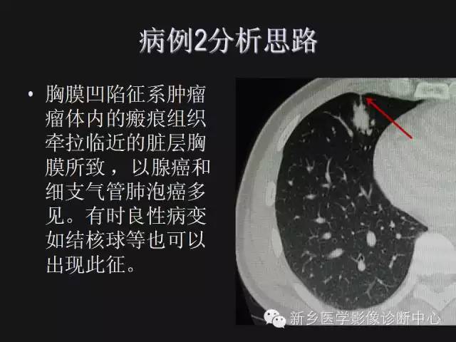 【病例】肺炎性假瘤2例影像表现与鉴别