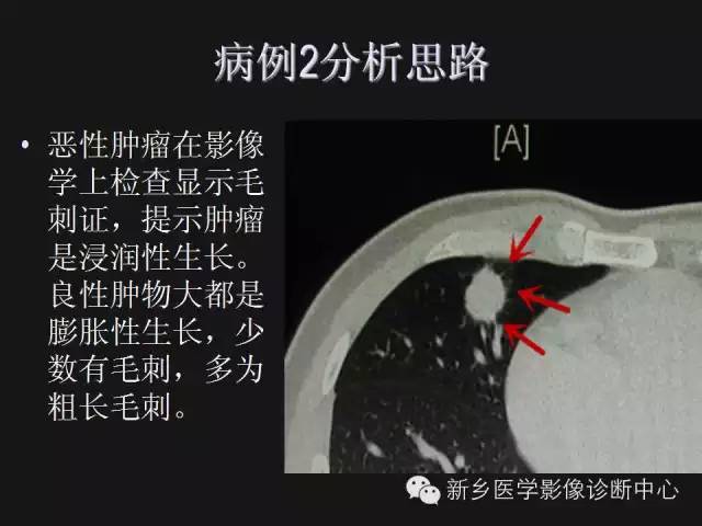 【病例】肺炎性假瘤2例影像表现与鉴别
