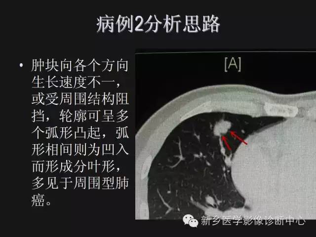【病例】肺炎性假瘤2例影像表现与鉴别