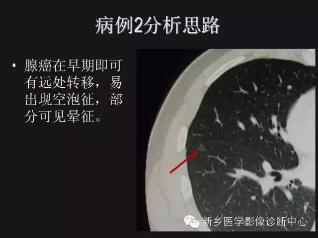 【病例】肺炎性假瘤2例影像表现与鉴别