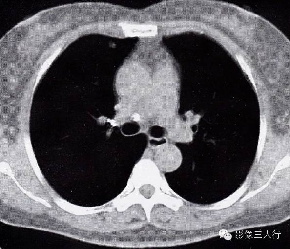 肺孤立性小点状结核的CT表现及鉴别诊断