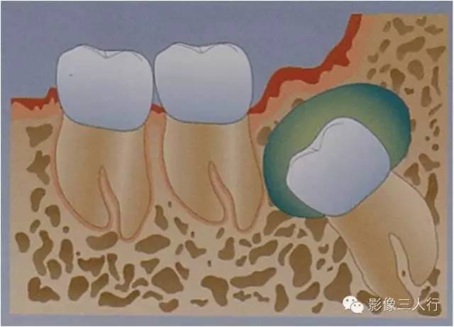 含牙囊肿 Dentigerous cyst 含牙囊肿 Dentigerous cyst