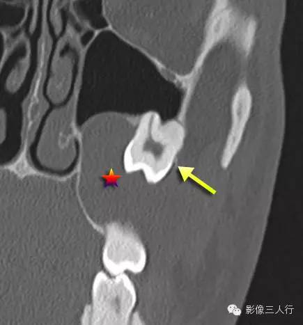 含牙囊肿 Dentigerous cyst 含牙囊肿 Dentigerous cyst