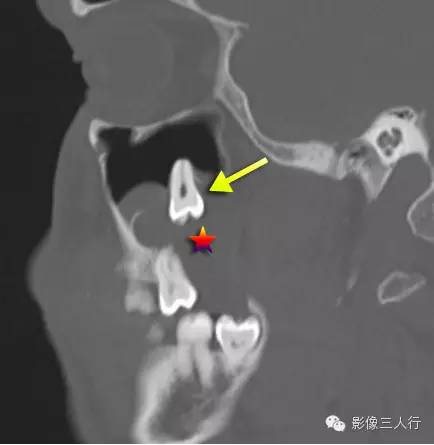 含牙囊肿 Dentigerous cyst 含牙囊肿 Dentigerous cyst