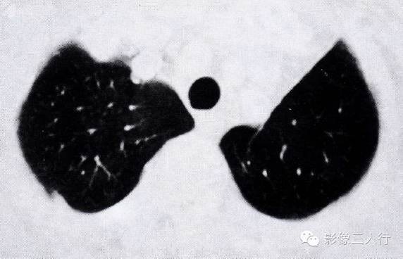 "磨玻璃影"的肺转移瘤CT表现及鉴别诊断