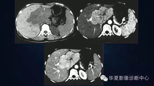 【PPT】肝癌的特殊CT表现