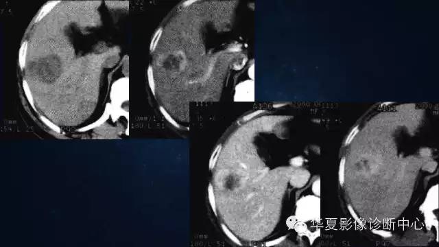 【PPT】肝癌的特殊CT表现