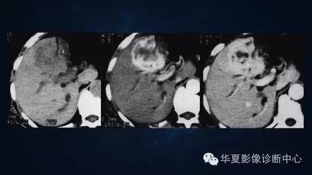 【PPT】肝癌的特殊CT表现