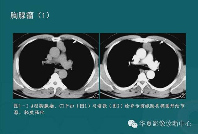 【PPT】纵隔良性肿瘤的放射诊断概述