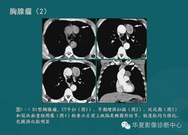 【PPT】纵隔良性肿瘤的放射诊断概述