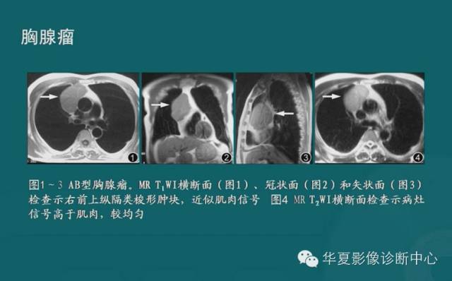 【PPT】纵隔良性肿瘤的放射诊断概述