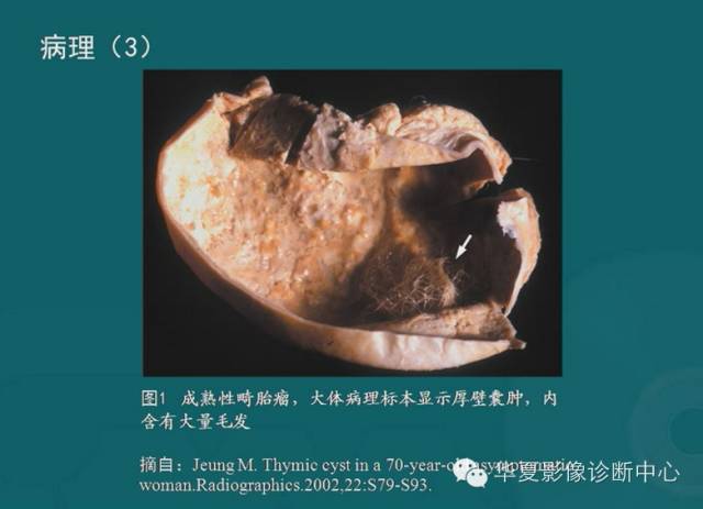【PPT】纵隔良性肿瘤的放射诊断概述