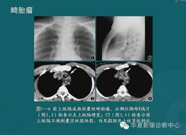 【PPT】纵隔良性肿瘤的放射诊断概述