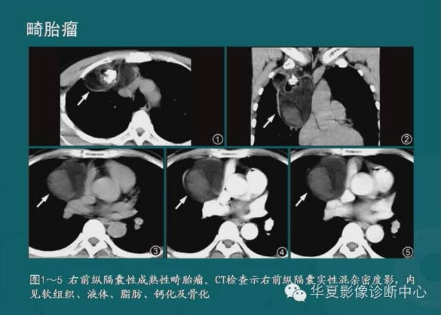 【PPT】纵隔良性肿瘤的放射诊断概述