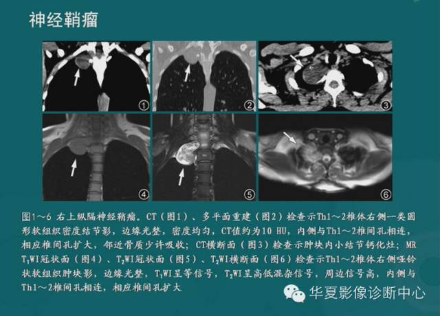 【PPT】纵隔良性肿瘤的放射诊断概述