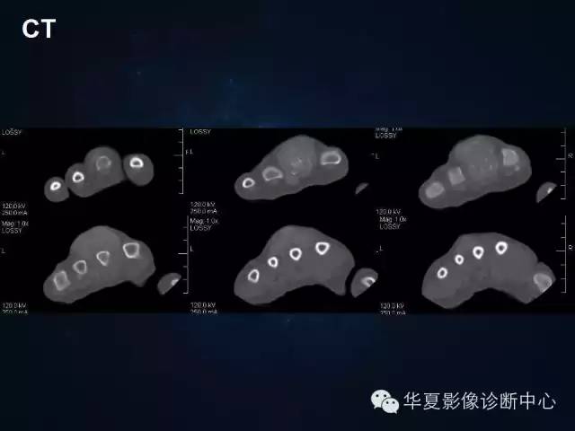 【病例】痛风1例影像表现