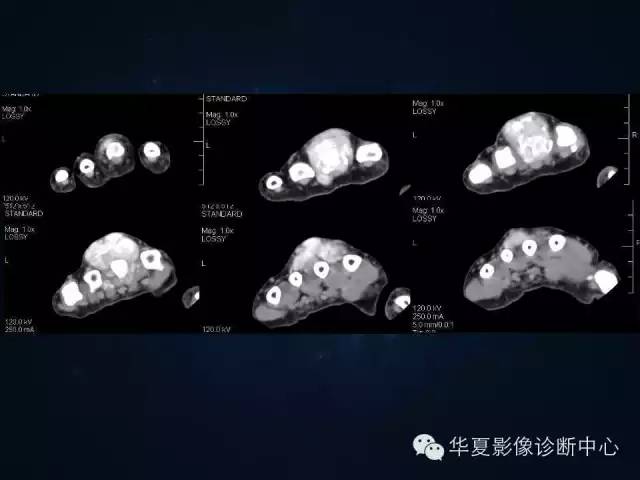 【病例】痛风1例影像表现