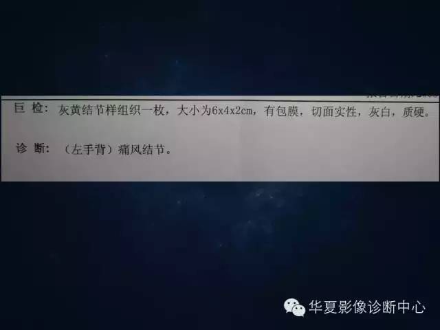 【病例】痛风1例影像表现