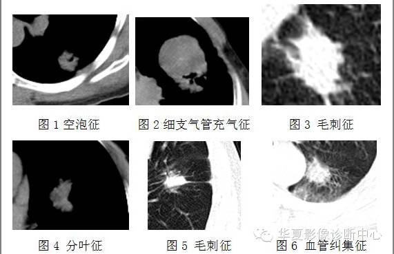在周围型肺癌的诊断中应该怎样看待典型征象？
