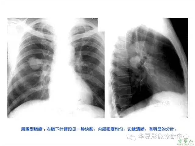 在周围型肺癌的诊断中应该怎样看待典型征象? 在周围型肺癌的诊断中应该怎样看待典型征象?