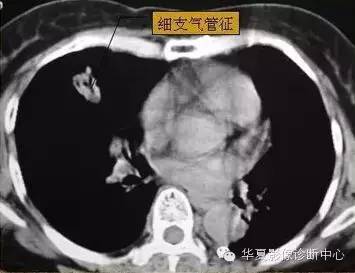 在周围型肺癌的诊断中应该怎样看待典型征象? 在周围型肺癌的诊断中应该怎样看待典型征象?