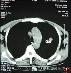 在周围型肺癌的诊断中应该怎样看待典型征象? 在周围型肺癌的诊断中应该怎样看待典型征象?