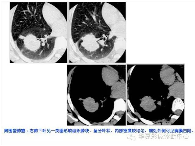 在周围型肺癌的诊断中应该怎样看待典型征象? 在周围型肺癌的诊断中应该怎样看待典型征象?