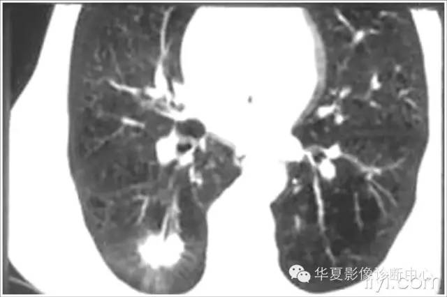 在周围型肺癌的诊断中应该怎样看待典型征象? 在周围型肺癌的诊断中应该怎样看待典型征象?