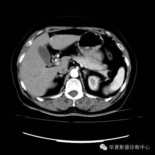 【病例】肾孟癌1例