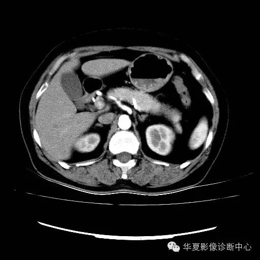 【病例】肾孟癌1例