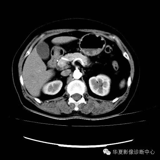 【病例】肾孟癌1例