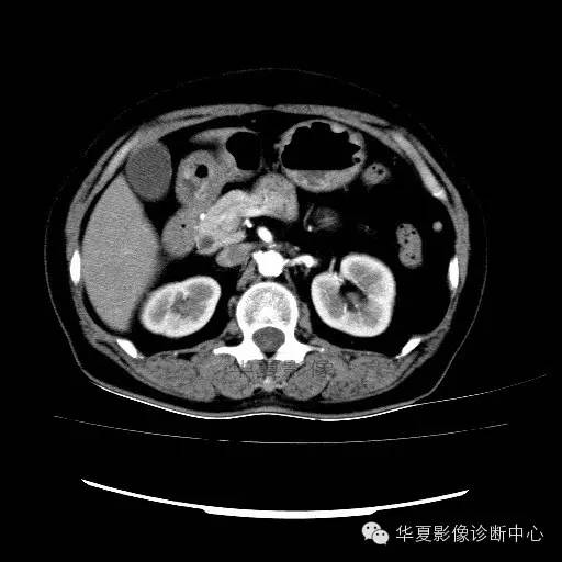 【病例】肾孟癌1例