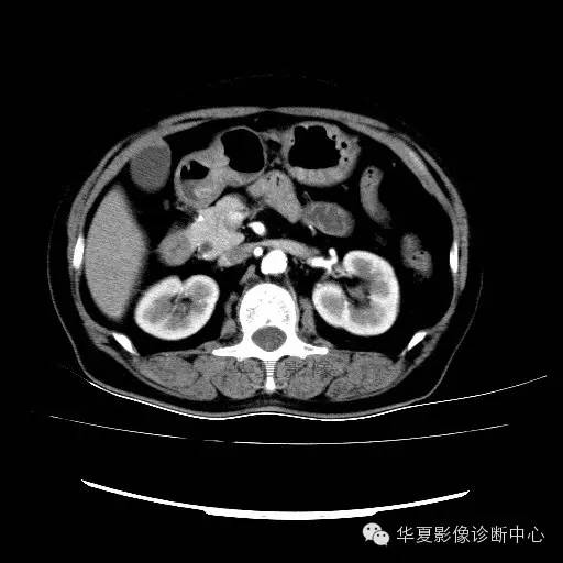 【病例】肾孟癌1例