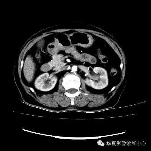 【病例】肾孟癌1例