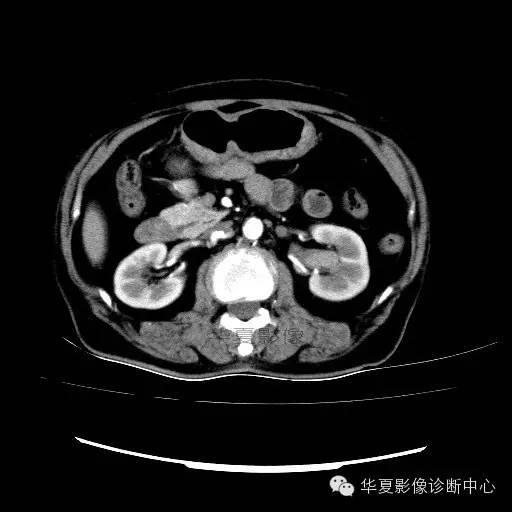【病例】肾孟癌1例