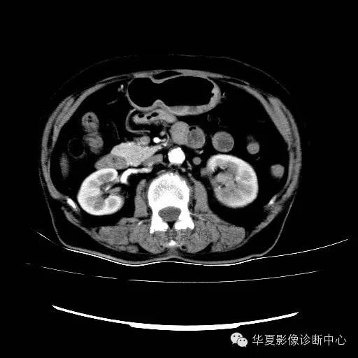 【病例】肾孟癌1例