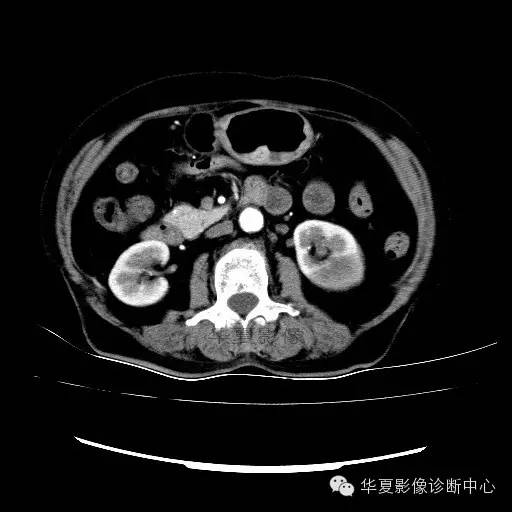 【病例】肾孟癌1例
