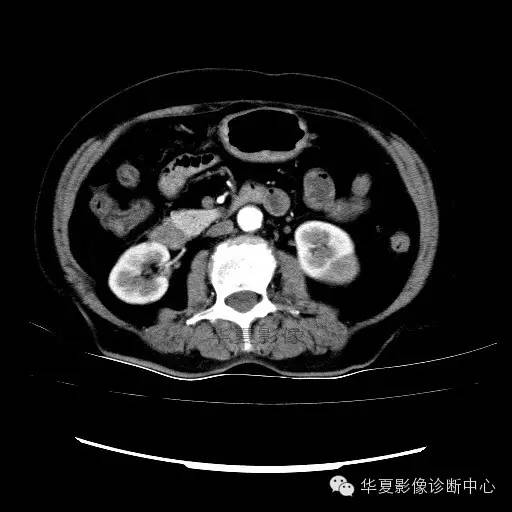 【病例】肾孟癌1例