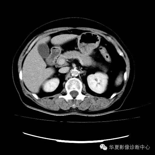 【病例】肾孟癌1例