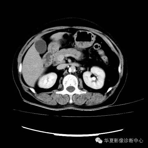 【病例】肾孟癌1例
