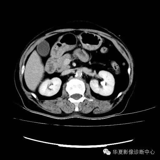 【病例】肾孟癌1例