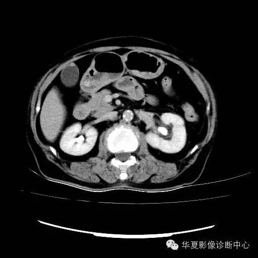 【病例】肾孟癌1例