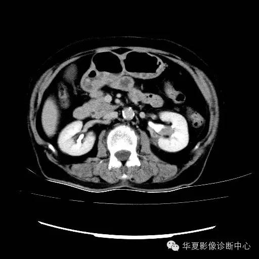 【病例】肾孟癌1例