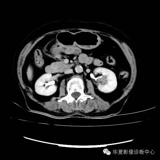 【病例】肾孟癌1例
