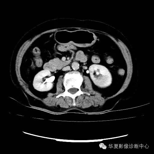 【病例】肾孟癌1例